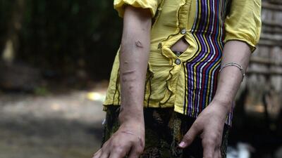San Kay Khine, a 17-year-old Myanmar child slave, shows her scarred arms and twisted fingers as she recovers at her family’s village in Baw Lone Kwin, outside of the capital Yangon. She is among the tens of thousands of children from poor rural areas who are sent to work as domestic helpers for the country’s growing pool of wealthier, urban middle-class households. Ye Aung Thu / AFP