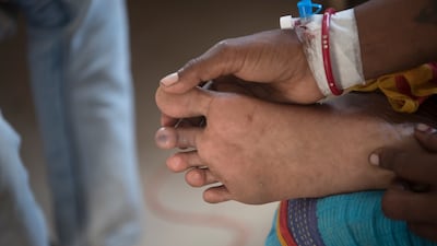 Manjula Devi, 30, shows a snake bite on her toes. She was treated at the Government Medical College and Hospital in Purnea in Bihar