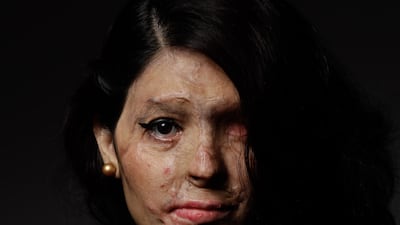 Reshma Qureshi has released a new book titled 'Being Reshma: The Extraordinary Story of an Acid Attack Survivor Who Took the World by Storm.'