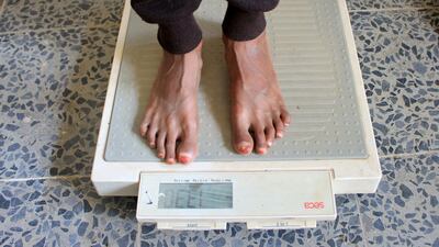 Malnourished boy Hassan Merzam Muhammad stands on a weight scale at a medical center in Abs district of Hajjah province, November 24. Reuters