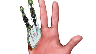 Abdul Rahim, a former Afghanistan miliatry captain who lost his hands defusing mines, had the hands of a traffic accident victim transplanted onto him in a 15-hour operation in India.