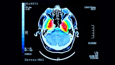 A molecule identified by Abu Dhabi researchers aims to bolster treatment options for patients. Getty Images