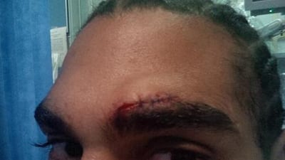 David Haye shows the cut above his eye which forced him to postpone the bout with Tyson Fury. Hayemaker Boxing