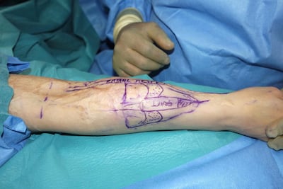 Skin grafts wre taken from elsewhere in her body, as a new nose was 'grown' for Heba Hosni on her forearm. Courtesy Dr. Mohan Rangaswamy