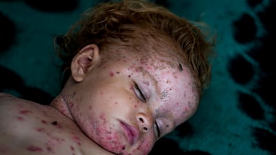 A Palestinian toddler suffering from a skin disease in Deir Al Balah. The spread of skin diseases has become rampant due to overcrowding. AP