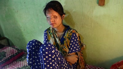 Indian acid attack survivor Reshma Qurashi rests in her home at a slum in the eastern suburbs of Mumbai. The Indian teenager’s voice trembles as she recalls the day she lost her face. Indranil Mukherjee/AFP Photo