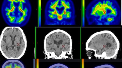 Right now, dementia trials suffer from low awareness, limited doctor referrals and strict eligibility criteria. Photo: CCAD