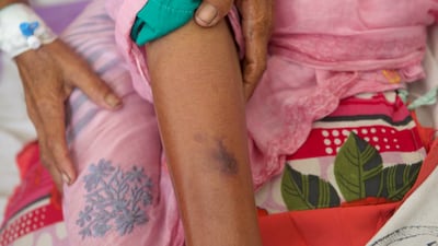 Jameela Khatoon, who is 70, was taken for treatment for the cobra bite at the Government Medical College and Hospital in Purnea in Bihar