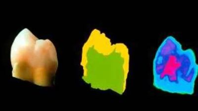 Terahertz images of tooth with an internal cavity. T-rays can determine the internal composition of objects as much as 20 metres away.