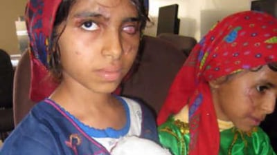 Athba Qasim al Sumaki, left, and Hana Qasim al Sumaki were injured in a landmine explosion that killed a third girl.