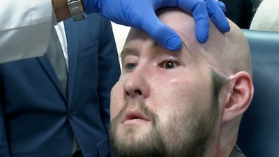 Surgeons in New York have reconstructed Aaron James's face and hope sight can be restored to the transplanted left eye. AP