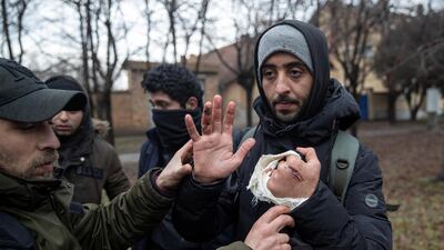 An injured migrant shows the wounds that he says were caused by Hungarian police in Horgos, Serbia on Tuesday. Reuters