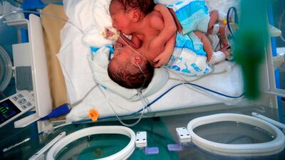 Newborn conjoined twins lie in an incubator at the child intensive care unit of al-Sabeen hospital in Yemen's capital Sanaa. The twins were born two days ago and share one heart, lungs, liver and pancreas. AFP