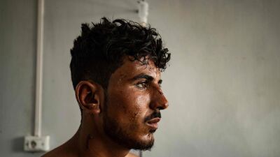 A man sits on his hospital bed in Hasakeh after suffering burns in a fire that broke out during a wedding party at Al Hol displacement camp in north-eastern Syria. AFP