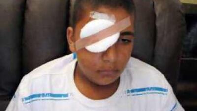 A child injured in a firework accident as part of a campaign to highlight the dangers of playing with fireworks.