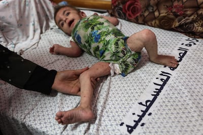 Palestinian baby girl Wateen Al Adasi, who developed a skin condition due to malnutrition, rests at the Kamal Adwan hospital in Beit Lahia in the northern Gaza Strip. AFP