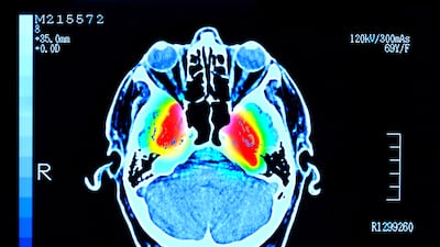 Scientists say the test could also help diagnose other progressive nervous system disorders earlier. Getty Images