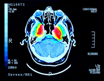 An MRI brain scan. Getty Images