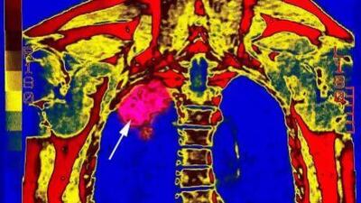 An image of a malignant tumour on the upper right lobe of a lung. In The Cancer Chronicles, author George Johnson points out that metastatic cancers have occurred in humans for millennia. BSIP / UIG Via Getty Images