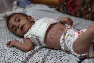 A Palestinian baby with a skin condition caused by malnutrition is treated at a hospital in Beit Lahia, northern Gaza. AFP