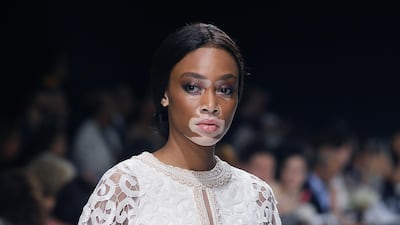 Canadian model Winnie Harlow suffers from vitiligo. Getty
