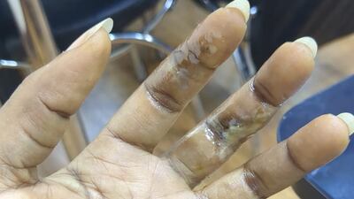 Ms Claire has burn injuries on her palms from holding on to an electric cable to break her fall from the fourth floor. Photo: Yemdzu Doris Claire