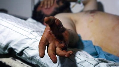 An injured man lies on a bed in a hospital in Syria’s northeastern city of Hassakeh on May 2, 2017, following an ISIL attack on a camp for displaced people near the country's border with Iraq. Delil Souleiman / AFP