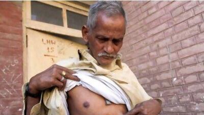 Abul Hasan, a former soldier, shows his scars while fighting alongside Pakistan troops in the 1971 war.