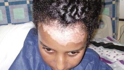The 23-year-old Ethiopian maid was admitted last month with first and second degree burns to her face, back and foot. Courtesy of Al Ittihad