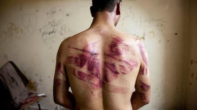 A Syrian man shows marks of torture on his back after he was released by regime forces in Aleppo. AFP
