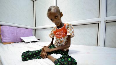 Saida Ahmad Baghili, 18, is suffering from severe acute malnutrition. She is pictured here at Al Thawra hospital in the Red Sea port of Hodeidah on October 24, 2016. Abduljabbar Zeyad/Reuters