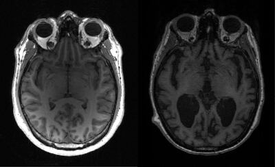 Alzheimer’s causes about two thirds of cases of dementia in over-65s and affects more than 44 million people worldwide. AFP