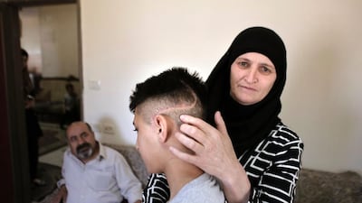 The mother of Palestinian teenager Ahmed Abu Al Homs shows a scar on her son's head at their home in east Jerusalem on April 7, 2016. The picture was taken a few months after Ahmed was wounded by sponge-tipped bullets. Ahmad Gharabli/AFP