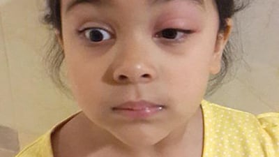 Mysha Kaipa says she came home from school last week with bites across her face. Courtesy Saba Kaipa