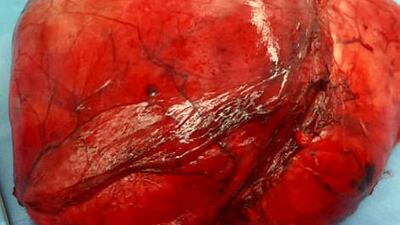 The tumour grew to a size of 30cm in diameter in just a few months. Courtesy SSMC