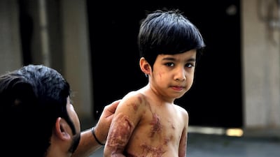 Abdul Rehman, 4, was badly burned three months ago after he accidentally tipped a can of acid onto himself. His father, Mohammed Iqbal, is uninsured and is struggling to pay for his medication. Satish Kumar for The National