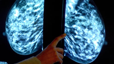 The Cancer Survival Calculator could be a valuable tool to help patients and their doctors make informed decisions about treatment. PA