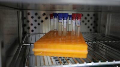 Cholera samples in a laboratory. Kuwait says it has treated a citizen who returned from abroad with the disease and advised the public. EPA