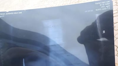 An undated picture made available on January 3, 2017, shows an abdominal X-ray of Ma Van Nhat, revealing a pair of partly broken scissors. EPA