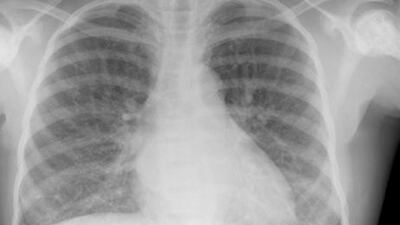 Typical findings on a chest X-ray in sickle cell disease, show a slightly enlarged heart. iStockphoto