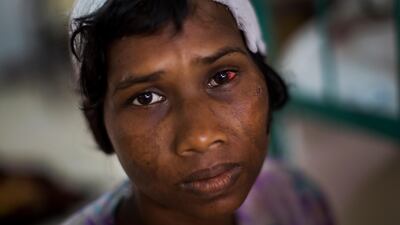 Rohingya woman Dildar Begum gets treatment at Sadar Hospital in Cox's Bazar, Bangladesh. Bernat Armangue / AP Photo