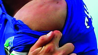 Italy’s Giorgio Chiellini shows teeth marks on his shoulder where he was bitten by Uruguay’s Luis Suarez, during their 2014 World Cup match at the Dunas arena in Natal in this June 24 photo. Tony Gentile / Reuters