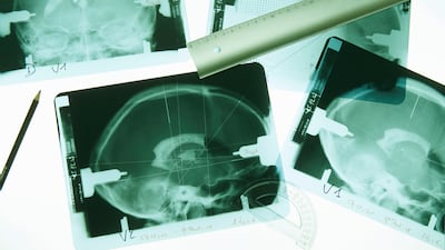 The neurological disorder of epilepsy has intrigued physicians for centuries. Getty Images