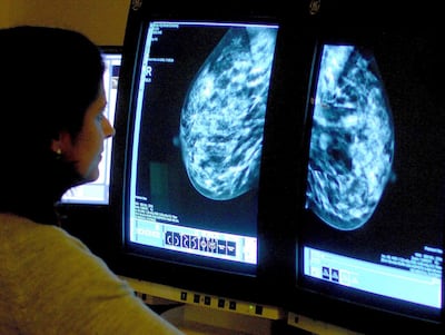A consultant examines a mammogram. New UAE research could support treatment of breast cancer patients. Photo: PA
