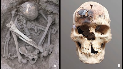 This undated combination photo provided by Hirofumi Matsumura shows a crouched mummy in Guangxi, China, with burn marks on its skull. AP