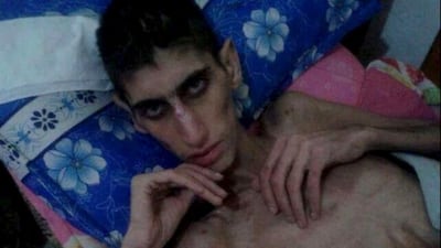 An emaciated man in Madaya reflects the widespread starvation in the rebel-held town blockaded by pro-Assad forces. (Syrian Observatory For Human Rights)