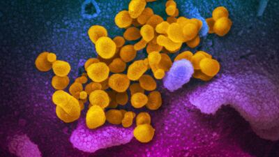 A microscope image of the Novel Coronavirus SARS-CoV-2 (yellow) emerging from the surface of cells, blue/pink, cultured in a lab. NIAID-RML via AP