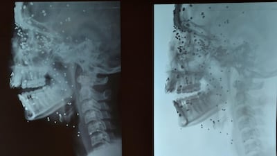 A photo taken at the ICU hospital in Srinagar on July 16, 2016, shows the X-ray of 14-year-old Insha Malik. Visible are the multiple pellets embedded in her face and head after she was shot by Indian security forces. Tauseef Mustafa / AFP