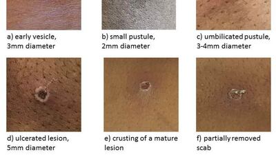 Images from the UK Health Security Agency show the stages of monkeypox. UK Health Security Agency