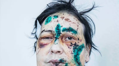 Yelena Buryanckenko covered in facial wounds and antiseptic dye in a Kharkiv hospital, in eastern Ukraine, after Russian missiles damaged her apartment block. Taken by Jack Hill. The Times/PA
